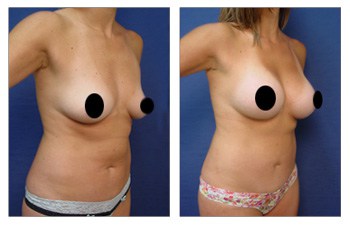 Tummy Tuck Los Angeles