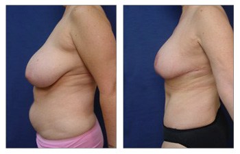 Patient 1482 Tummy Tuck, Breast Reduction, Mommy Makeover Before