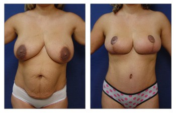 Tummy Tuck, Liposuction, Vaser Lipo