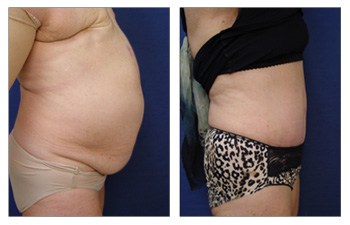 Before and after surgery result of eliminating a bulging belly with a tummy tuck