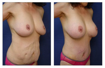 After surgery result of elimination of Abdominal Scar Following Tummy Tuck