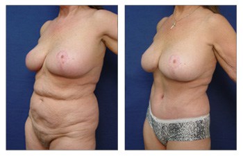 Eliminating Upper Abdominal Skin Rolls with Tummy Tuck