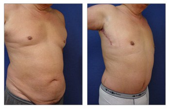 Tummy Tuck for Men  Torso Tuck Surgery