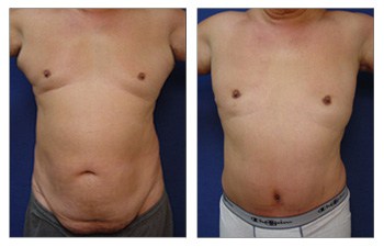 Male Tummy Tuck To Reduce Abdominal Girth - Our Surgical Team