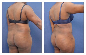 Tummy Tuck With 360 Body Contouring