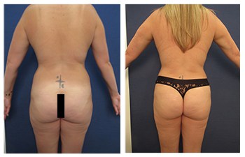 High Definition Brazilian Buttocks Lift (Buttocks shaping)