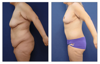 Post Bariatric Body Lift Los Angeles