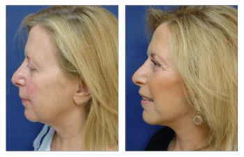 Fat Transfer for Lower Eyelids Los Angeles