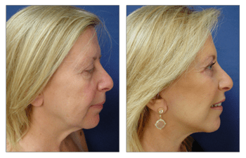 Fat Transfer for Lower Eyelids