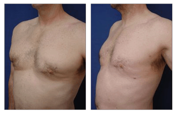 Fat Transfer Following Botched Gynecomastia