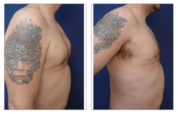 Fat Transfer Following Botched Gynecomastia