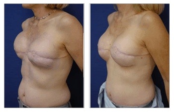 Fat Transfer Following Breast Radiation