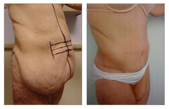 Bariatric surgery