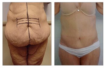 After Gastric Bypass Surgery-Plastic Surgery