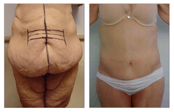 Post Bariatric Body Contouring - Dr. Laguna - Orange County