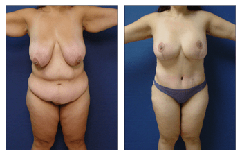 After Gastric Bypass Surgery-Plastic Surgery