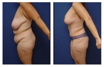 Plastic Surgery After Weight Loss