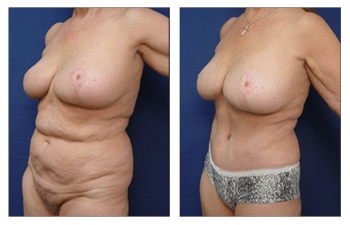 Will Insurance Cover a Body Lift  Cosmetic Plastic Surgery Institute