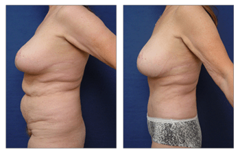 Circumferential Lipectomy (Body Lift) - The Coastal Clinic Plastic