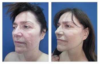 How Do You Get Natural Facelift Results