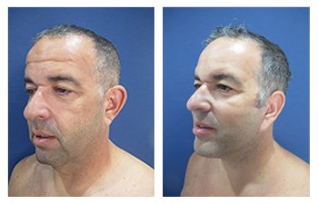 How Do You Get Natural Facelift Results