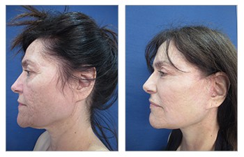 How Do You Get Natural Facelift Results