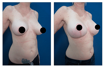 Breast Implant Surgery: Breast Implants Under The Muscle