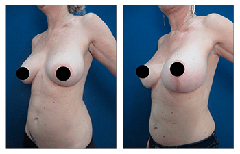 Breast lift with implants over the muscle - after surgery