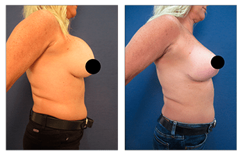 Surgery result of a boob job to fix operated looking breasts