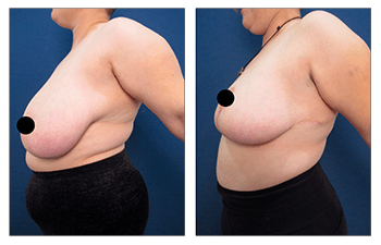Breast Reduction Post-Surgery Must-Haves
