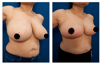 Eliminating redness over lower breast following breast lift