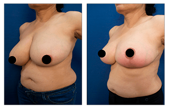 Eliminating redness over lower breast following breast lift