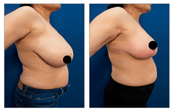 Treating the Not-So-Sexy Side Boob after Breast Reduction