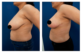 Redness Over Lower Breast Following Breast Lift