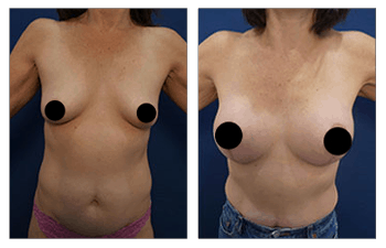 Images of patients after the expensive breast lift with implants