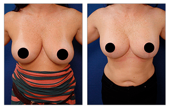 Corrected breast lift round out surgery