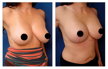 Corrected breast lift round out surgery