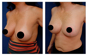 Corrected breast lift round out surgery