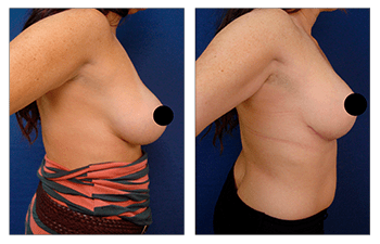 Corrected breast lift round out surgery