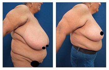 Breast Reduction Archives