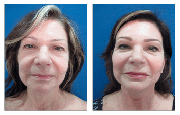 How Do You Get Natural Facelift Results