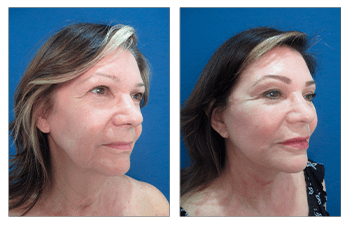 How Do You Get Natural Facelift Results