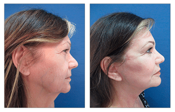 How to Achieve Natural Facelift Results - Los Angeles, CA