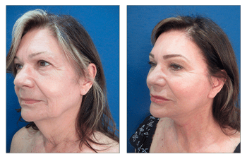 How Do You Get Natural Facelift Results