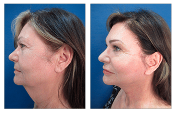 How Do You Get Natural Facelift Results