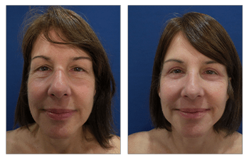 No upper eyelid surgery goes wrong - before and after result