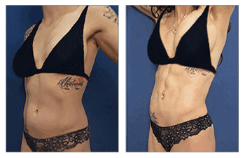 abdominal-etching-before-after-hd-vaser-lipo-mowlavi-02-copy-1-400x257-1