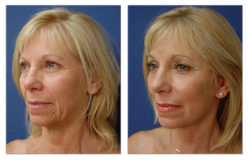 Face Lift Surgery Cost -  before and after surgery