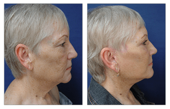 Facelift for Men Newport Beach & Orange County