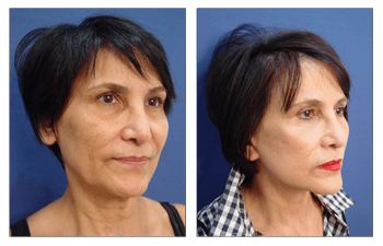 Best Facelift Surgeon